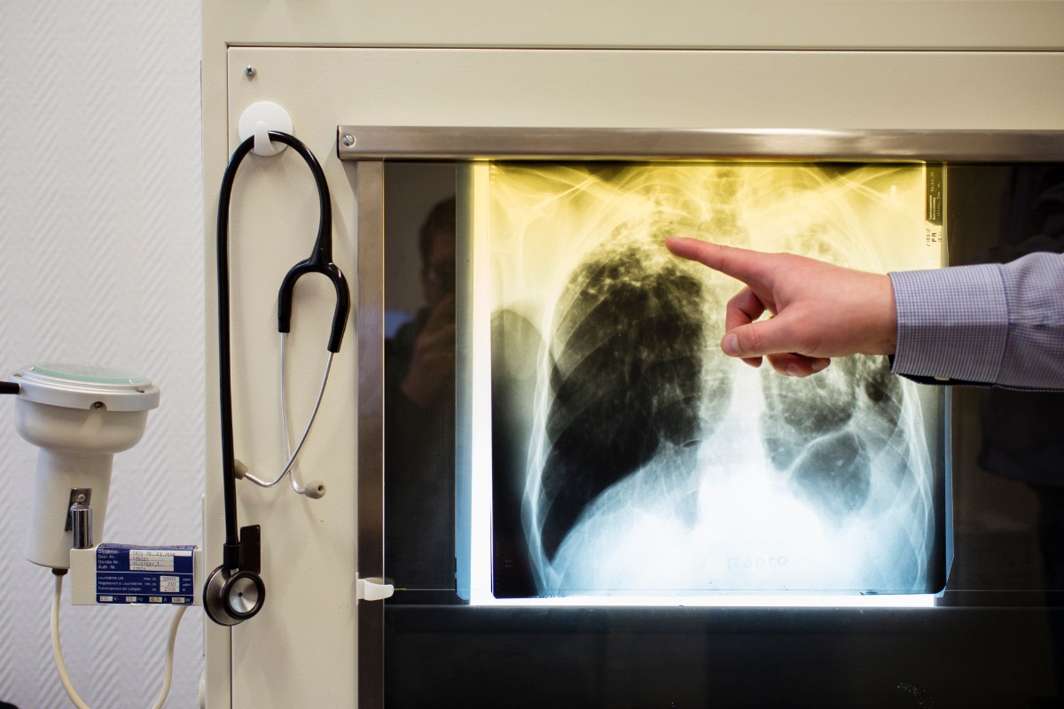 Al menos 20 sanitarios de Ceuta, en estudio tras atender sin protección a un paciente llegado de Marruecos con tuberculosis «altamente contagiosa»